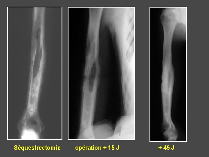 Séquestrectomie opération + 15 J + 45 J 