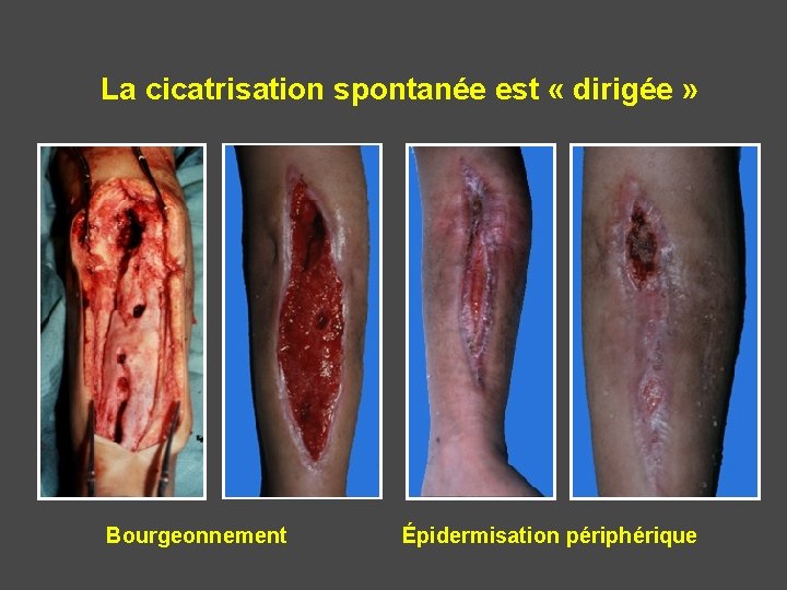 La cicatrisation spontanée est « dirigée » Bourgeonnement Épidermisation périphérique 