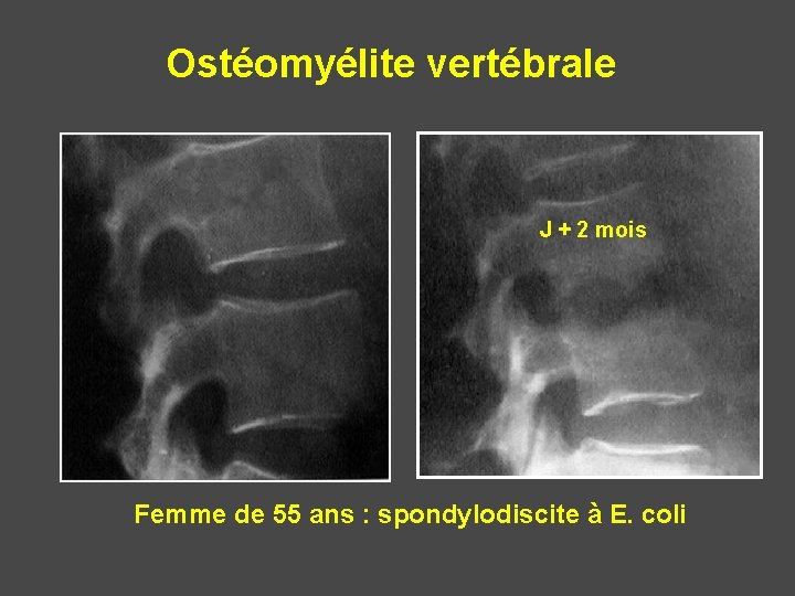 Ostéomyélite vertébrale J + 2 mois Femme de 55 ans : spondylodiscite à E.