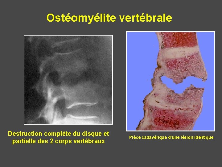 Ostéomyélite vertébrale Destruction complète du disque et partielle des 2 corps vertébraux Pièce cadavérique