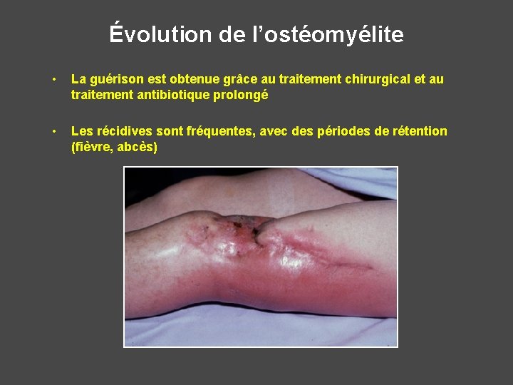 Évolution de l’ostéomyélite • La guérison est obtenue grâce au traitement chirurgical et au