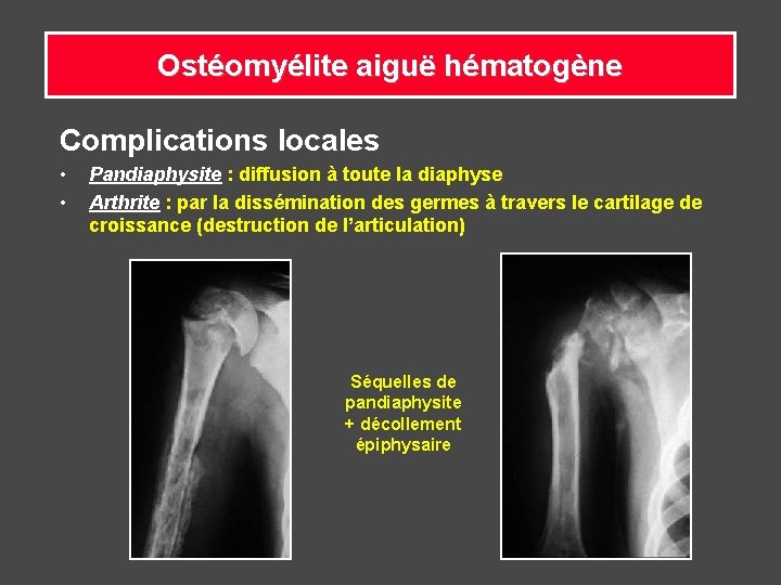 Ostéomyélite aiguë hématogène Complications locales • • Pandiaphysite : diffusion à toute la diaphyse