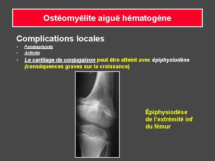 Ostéomyélite aiguë hématogène Complications locales • • Pandiaphysite Arthrite • Le cartilage de conjugaison