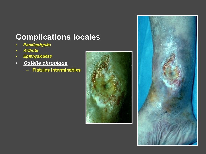 Complications locales • • • Pandiaphysite Arthrite Épiphysiodèse • Ostéite chronique – Fistules interminables