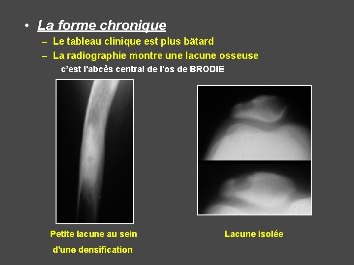  • La forme chronique – Le tableau clinique est plus bâtard – La