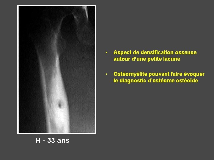 H - 33 ans • Aspect de densification osseuse autour d’une petite lacune •