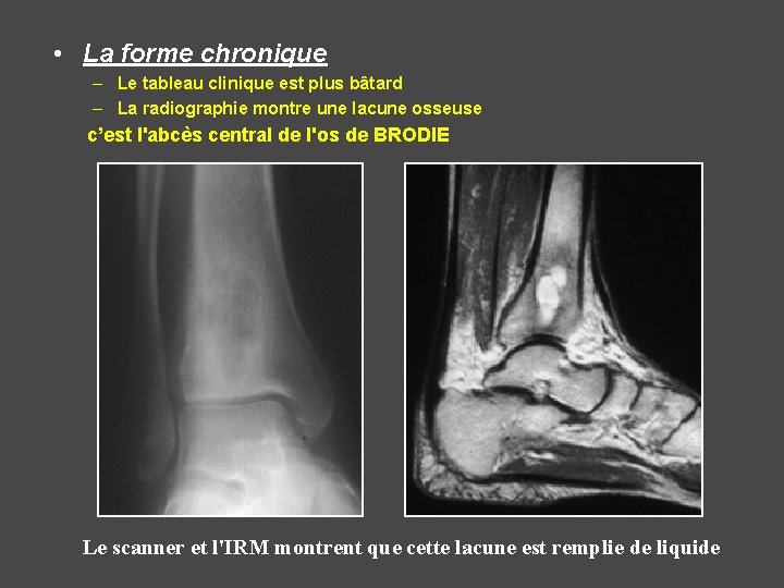  • La forme chronique – Le tableau clinique est plus bâtard – La