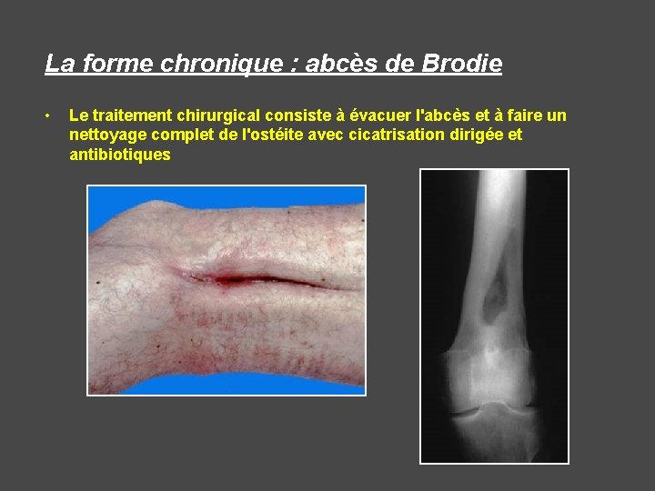 La forme chronique : abcès de Brodie • Le traitement chirurgical consiste à évacuer