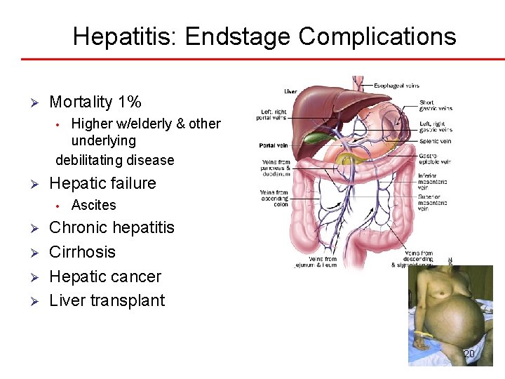 Hepatitis: Endstage Complications Ø Mortality 1% Higher w/elderly & other underlying debilitating disease •