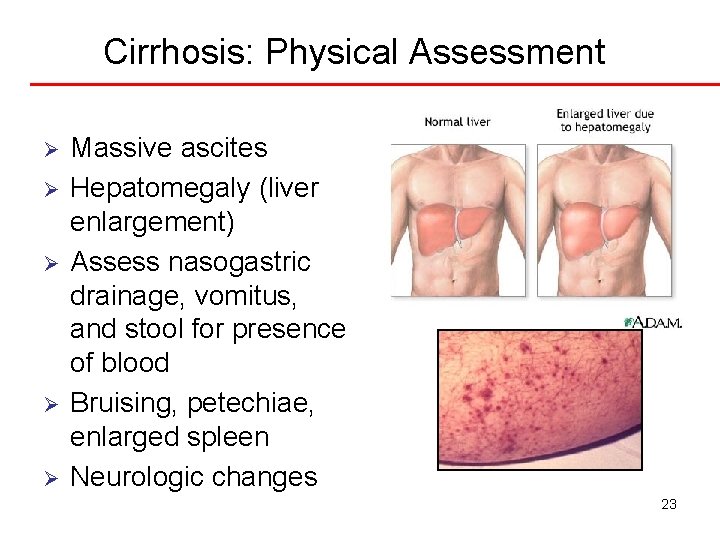 Cirrhosis: Physical Assessment Ø Ø Ø Massive ascites Hepatomegaly (liver enlargement) Assess nasogastric drainage,