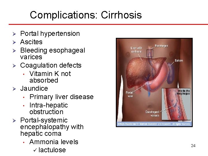 Complications: Cirrhosis Ø Ø Ø Portal hypertension Ascites Bleeding esophageal varices Coagulation defects •