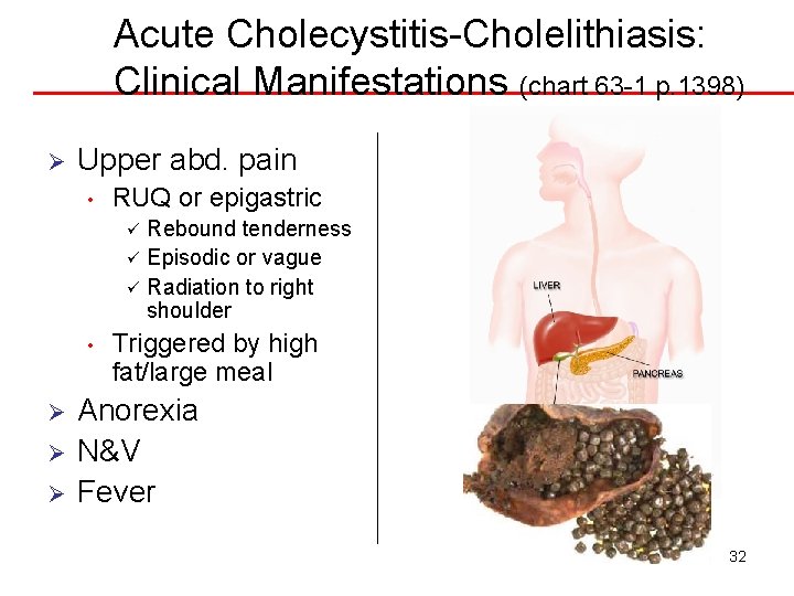 Acute Cholecystitis-Cholelithiasis: Clinical Manifestations (chart 63 -1 p. 1398) Ø Upper abd. pain •