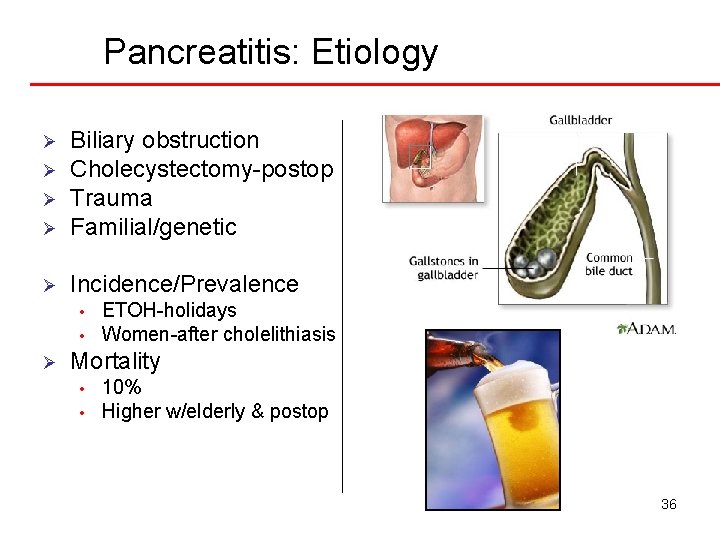 Pancreatitis: Etiology Ø Biliary obstruction Cholecystectomy-postop Trauma Familial/genetic Ø Incidence/Prevalence Ø Ø Ø •