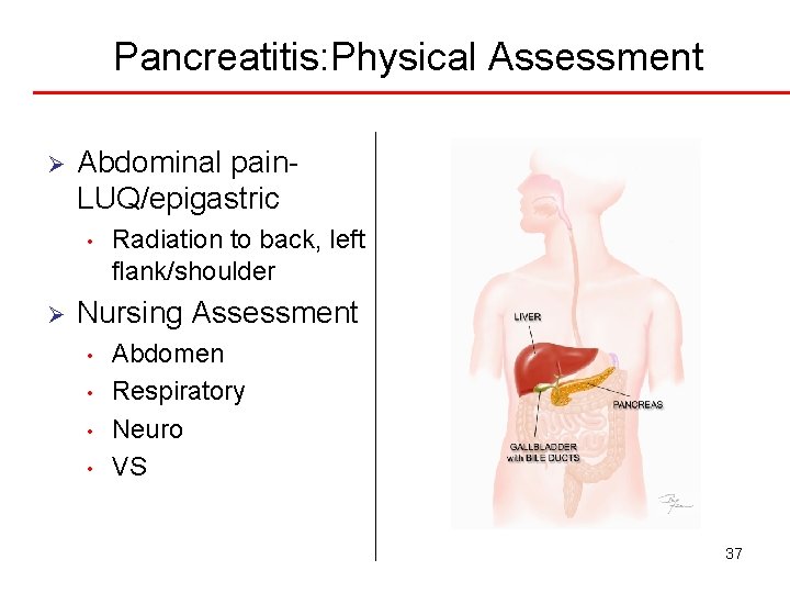 Pancreatitis: Physical Assessment Ø Abdominal pain. LUQ/epigastric • Ø Radiation to back, left flank/shoulder