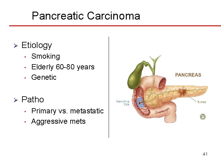 Pancreatic Carcinoma Ø Etiology • • • Ø Smoking Elderly 60 -80 years Genetic