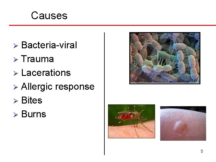 Causes Bacteria-viral Ø Trauma Ø Lacerations Ø Allergic response Ø Bites Ø Burns Ø