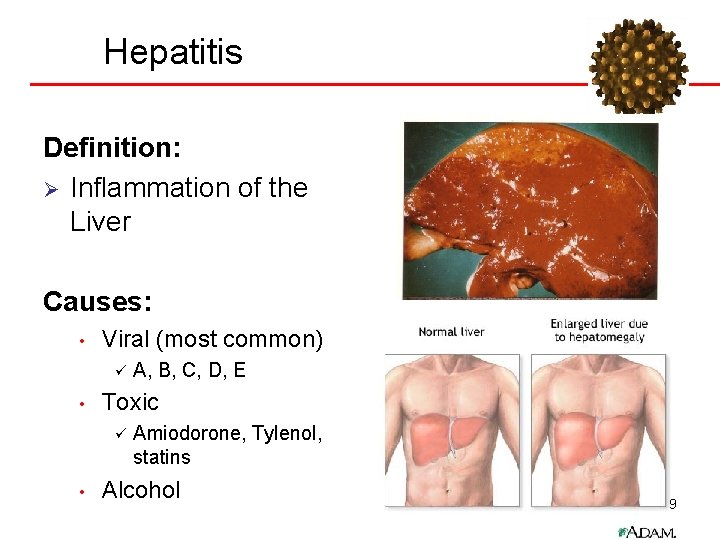 Hepatitis Definition: Ø Inflammation of the Liver Causes: • Viral (most common) ü •