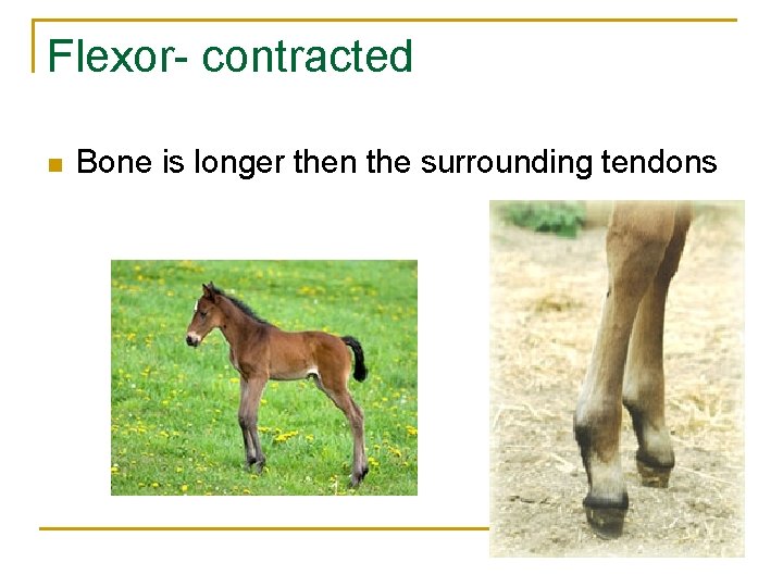 Flexor- contracted n Bone is longer then the surrounding tendons 