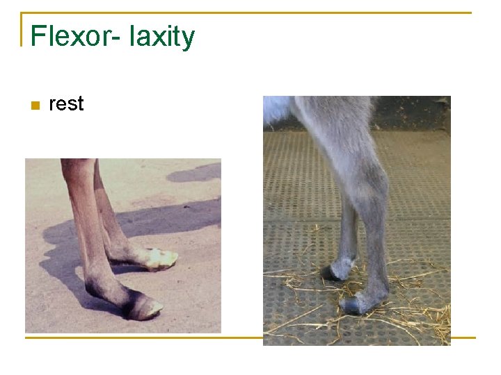 Flexor- laxity n rest 