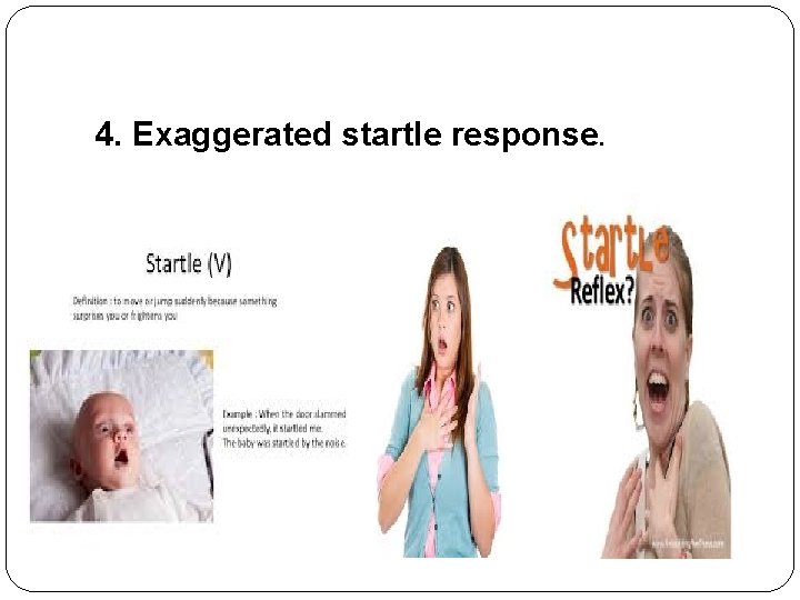 4. Exaggerated startle response. 4. Exaggerated startle response.