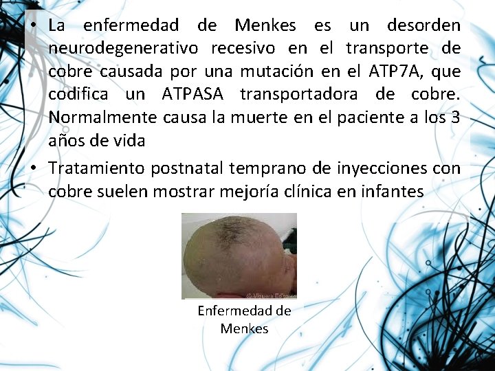  • La enfermedad de Menkes es un desorden neurodegenerativo recesivo en el transporte
