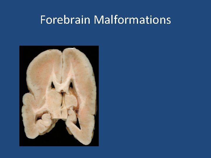 Forebrain Malformations 