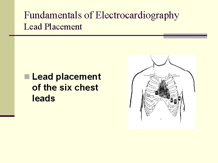 Fundamentals of Electrocardiography Lead Placement n Lead placement of the six chest leads Fundamentals of Electrocardiography Lead Placement n Lead placement of the six chest leads