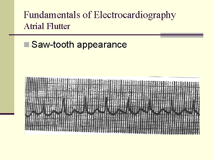 Fundamentals of Electrocardiography Atrial Flutter n Saw-tooth appearance Fundamentals of Electrocardiography Atrial Flutter n Saw-tooth appearance