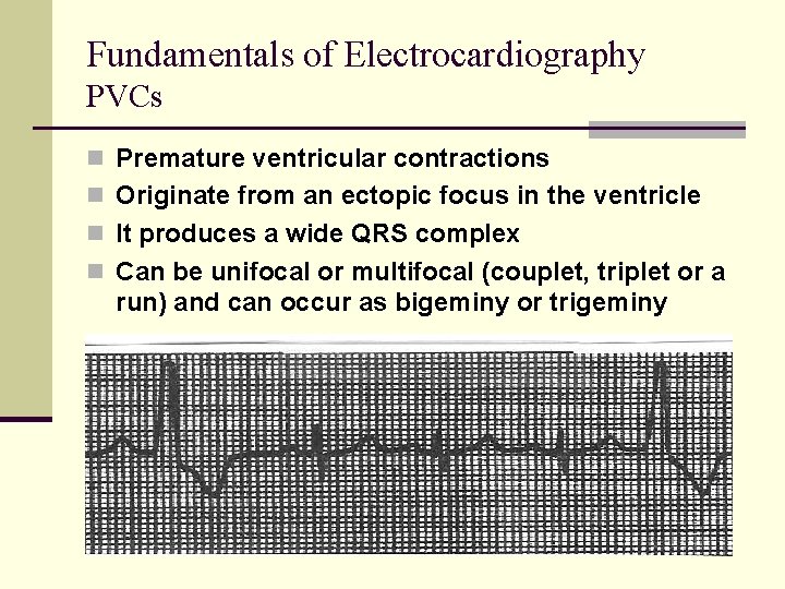 Fundamentals of Electrocardiography PVCs n Premature ventricular contractions n Originate from an ectopic focus Fundamentals of Electrocardiography PVCs n Premature ventricular contractions n Originate from an ectopic focus