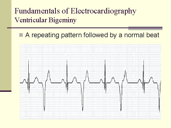 Fundamentals of Electrocardiography Ventricular Bigeminy n A repeating pattern followed by a normal beat Fundamentals of Electrocardiography Ventricular Bigeminy n A repeating pattern followed by a normal beat