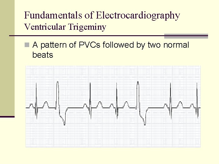 Fundamentals of Electrocardiography Ventricular Trigeminy n A pattern of PVCs followed by two normal Fundamentals of Electrocardiography Ventricular Trigeminy n A pattern of PVCs followed by two normal