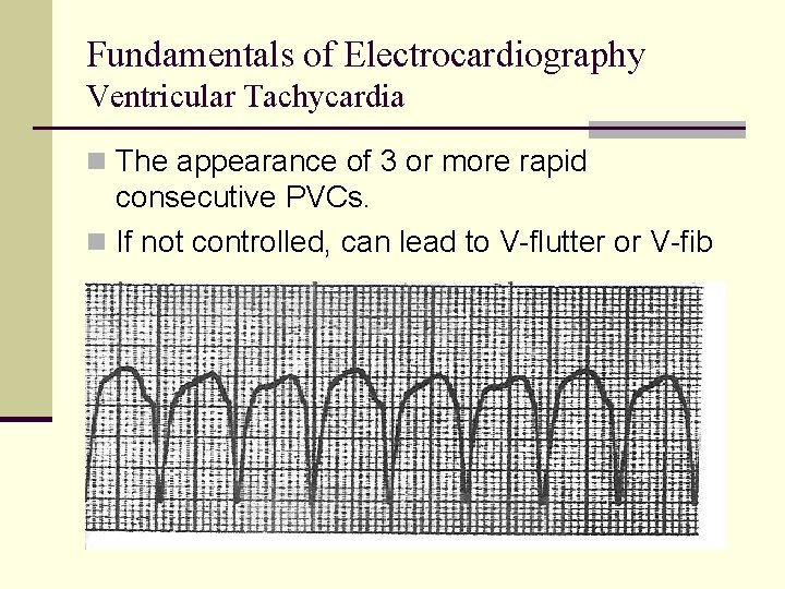 Fundamentals of Electrocardiography Ventricular Tachycardia n The appearance of 3 or more rapid consecutive Fundamentals of Electrocardiography Ventricular Tachycardia n The appearance of 3 or more rapid consecutive
