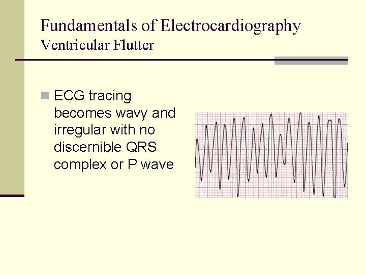 Fundamentals of Electrocardiography Ventricular Flutter n ECG tracing becomes wavy and irregular with no Fundamentals of Electrocardiography Ventricular Flutter n ECG tracing becomes wavy and irregular with no