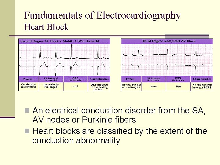 Fundamentals of Electrocardiography Heart Block n An electrical conduction disorder from the SA, AV Fundamentals of Electrocardiography Heart Block n An electrical conduction disorder from the SA, AV
