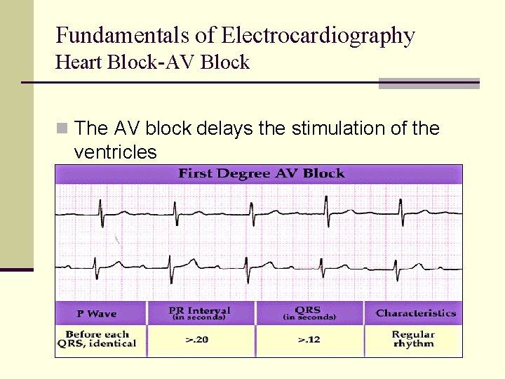 Fundamentals of Electrocardiography Heart Block-AV Block n The AV block delays the stimulation of Fundamentals of Electrocardiography Heart Block-AV Block n The AV block delays the stimulation of