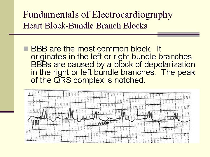 Fundamentals of Electrocardiography Heart Block-Bundle Branch Blocks n BBB are the most common block. Fundamentals of Electrocardiography Heart Block-Bundle Branch Blocks n BBB are the most common block.