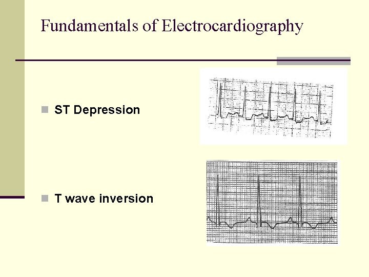 Fundamentals of Electrocardiography n ST Depression n T wave inversion Fundamentals of Electrocardiography n ST Depression n T wave inversion