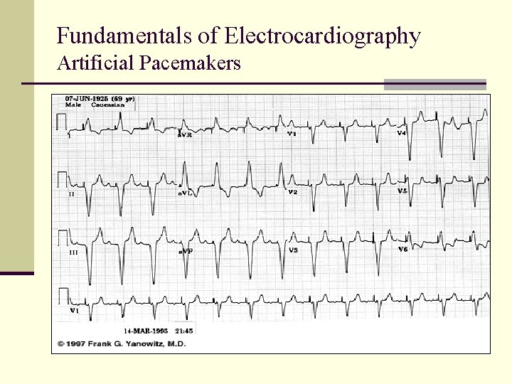 Fundamentals of Electrocardiography Artificial Pacemakers Fundamentals of Electrocardiography Artificial Pacemakers