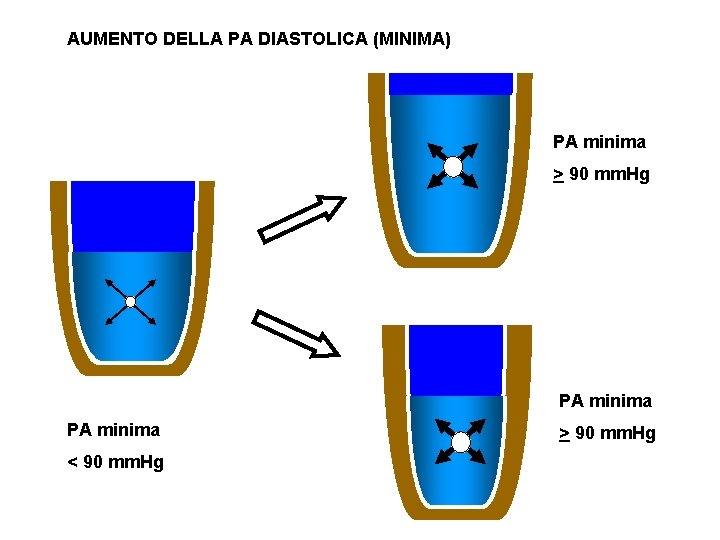 AUMENTO DELLA PA DIASTOLICA (MINIMA) PA minima > 90 mm. Hg PA minima <