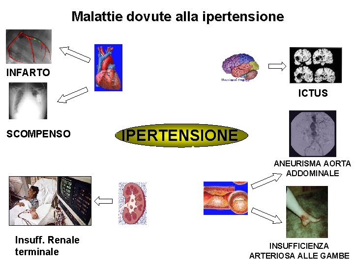 Malattie dovute alla ipertensione INFARTO ICTUS SCOMPENSO IPERTENSIONE ANEURISMA AORTA ADDOMINALE Insuff. Renale terminale