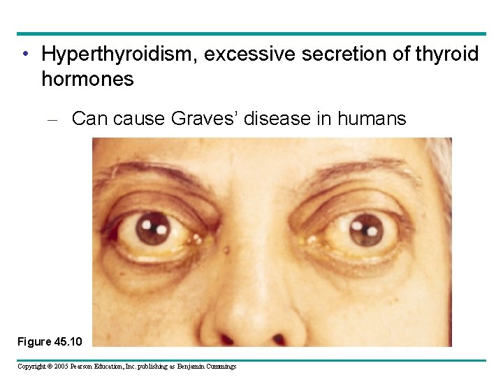  • Hyperthyroidism, excessive secretion of thyroid hormones – Can cause Graves’ disease in