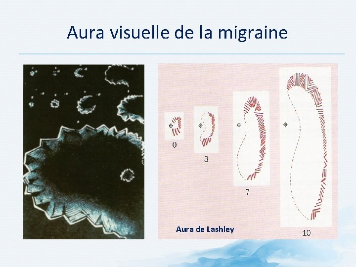 Aura visuelle de la migraine Aura de Lashley Aura visuelle de la migraine Aura de Lashley