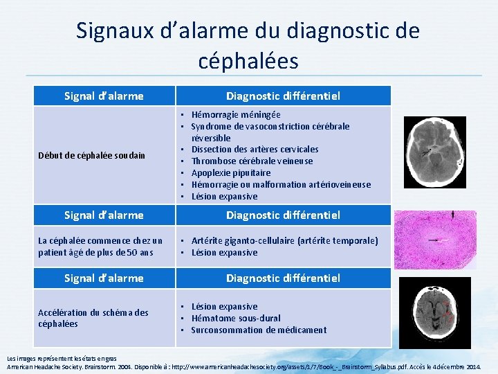 Signaux d’alarme du diagnostic de céphalées Signal d’alarme Début de céphalée soudain Signal d’alarme Signaux d’alarme du diagnostic de céphalées Signal d’alarme Début de céphalée soudain Signal d’alarme