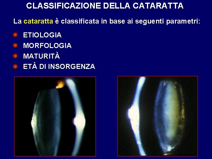 CLASSIFICAZIONE DELLA CATARATTA La cataratta è classificata in base ai seguenti parametri: ETIOLOGIA MORFOLOGIA