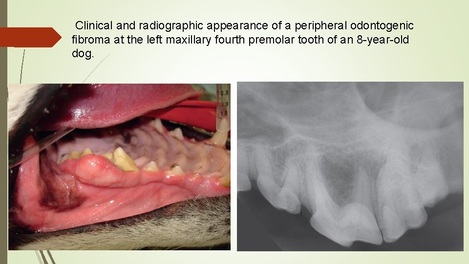 Clinical and radiographic appearance of a peripheral odontogenic fibroma at the left maxillary fourth