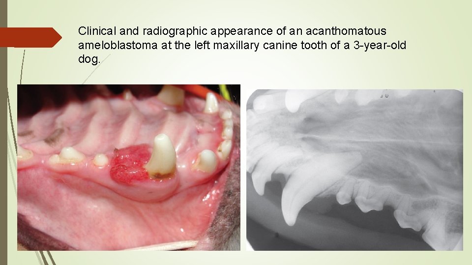 Clinical and radiographic appearance of an acanthomatous ameloblastoma at the left maxillary canine tooth