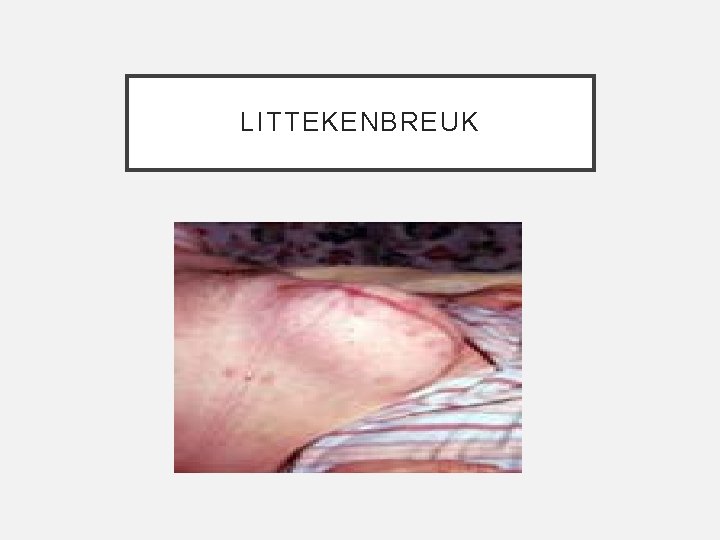 LITTEKENBREUK 