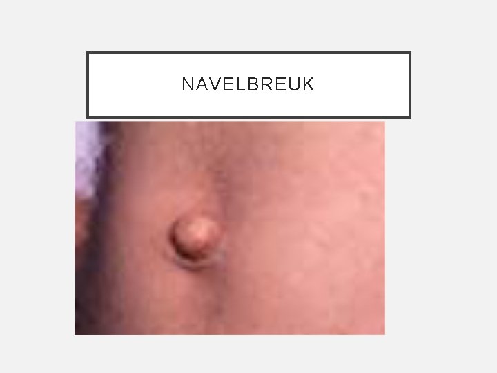 NAVELBREUK 