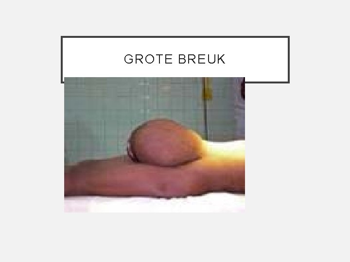 GROTE BREUK 