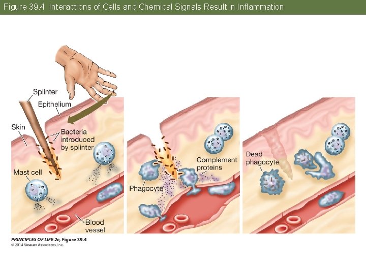 Figure 39. 4 Interactions of Cells and Chemical Signals Result in Inflammation 